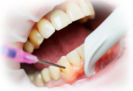 удаление кисты зуба лазером