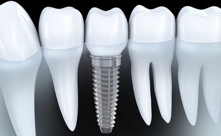 ustanovka-zubnyih-implantov-02.jpg