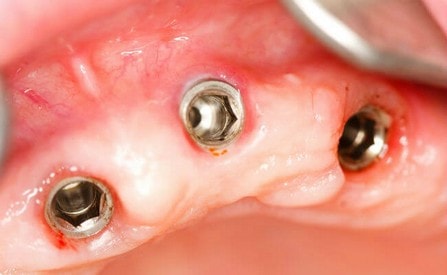 ustanovka-zubnogo-implanta-01.jpg